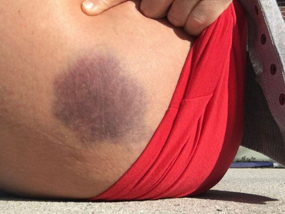 Large purple bruise on a woman's hip.