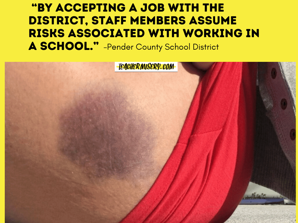 Large bruise on teacher's leg.